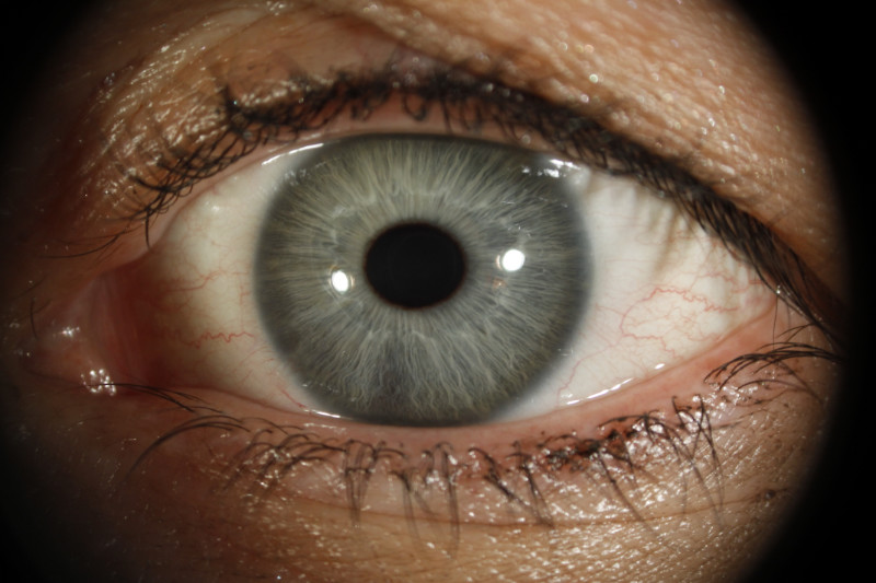 Neurogene Iris einer Patientin